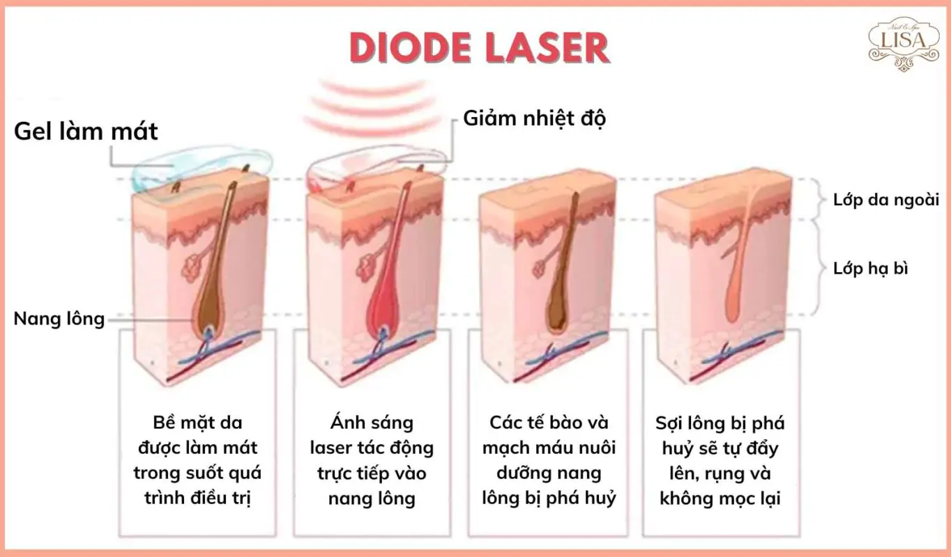 triet-long-diode-laser-1364x800