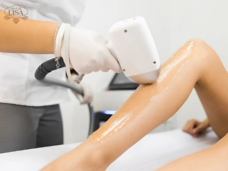 Công nghệ triệt lông laser