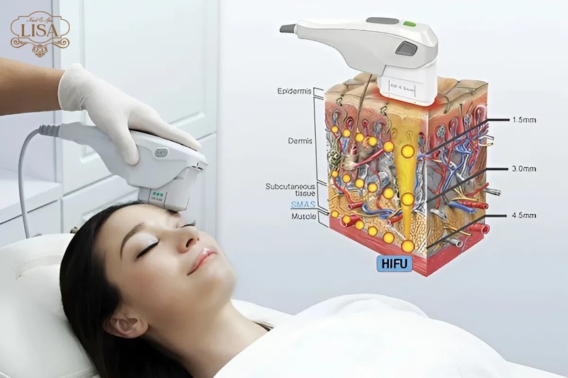Công nghệ cao HIFU (High-Intensity Focused Ultrasound)