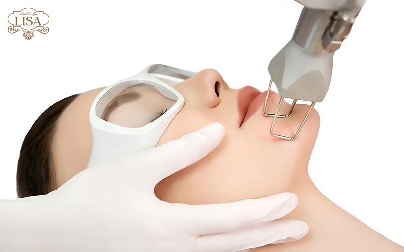 Công nghệ trị sẹo CO2 Fractional Laser