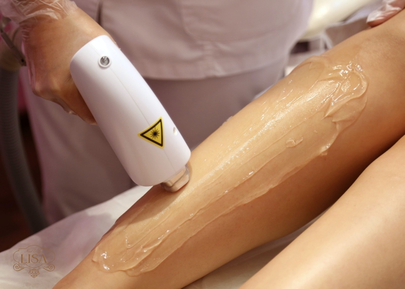 Triệt lông bằng máy laser scale 1