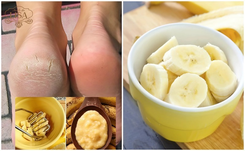 Dùng chuối chín khắc phục nứt gót chân vào mùa đông