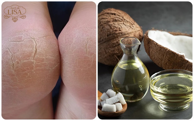 Cách chữa nẻ gót chân bằng dầu dừa