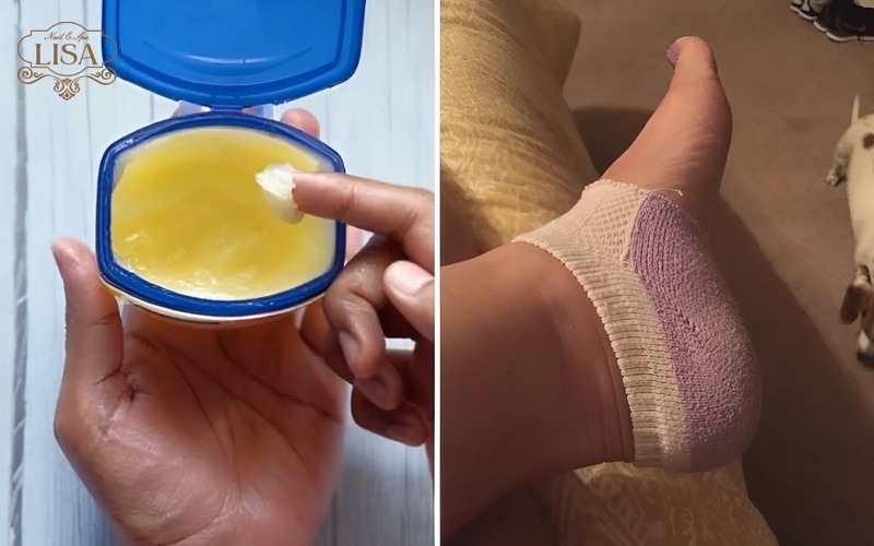 Cách chữa nứt gót chân bằng vaseline