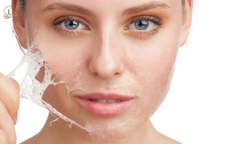 Chăm sóc da sau khi điều trị nám: Những lưu ý quan trọng