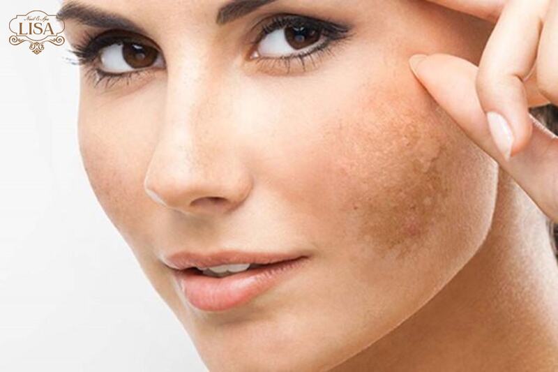 Chăm sóc da sau khi điều trị nám: Những lưu ý quan trọng