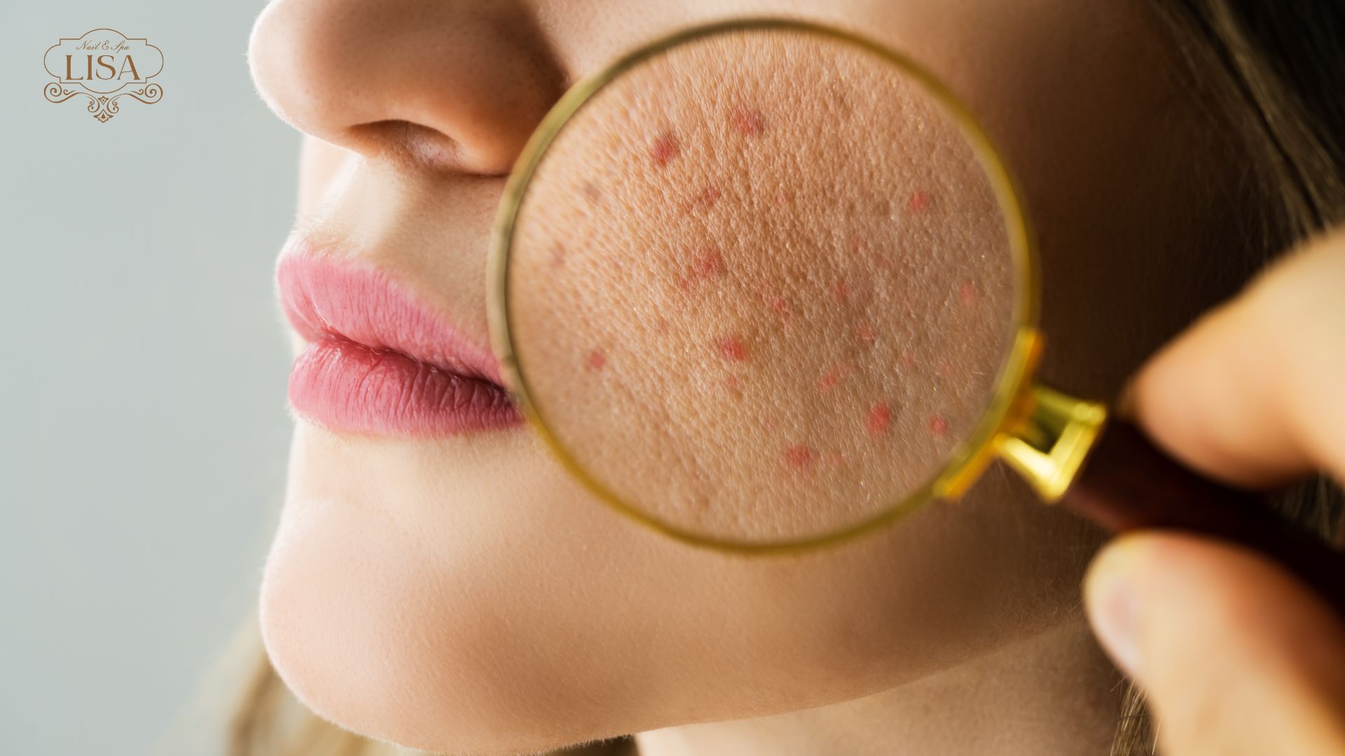 Mụn người lớn (Adult Acne)