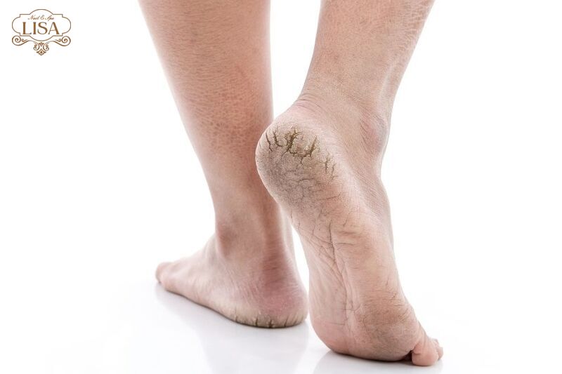 Làm sao để gót chân không bị nứt? Chuyên gia giải đáp