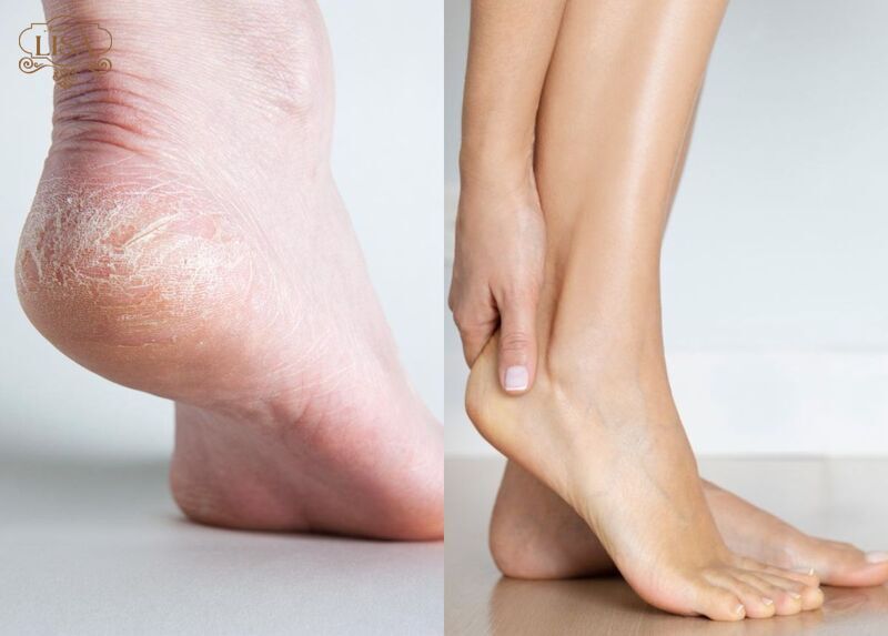 Làm sao để gót chân không bị nứt? Chuyên gia giải đáp