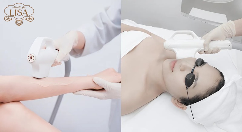 Công nghệ triệt lông IPL là gì?