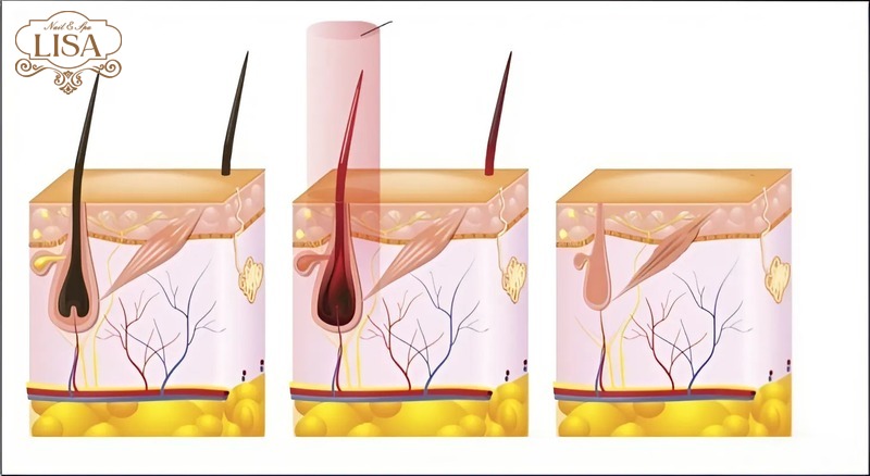 Công nghệ triệt lông IPL là gì?