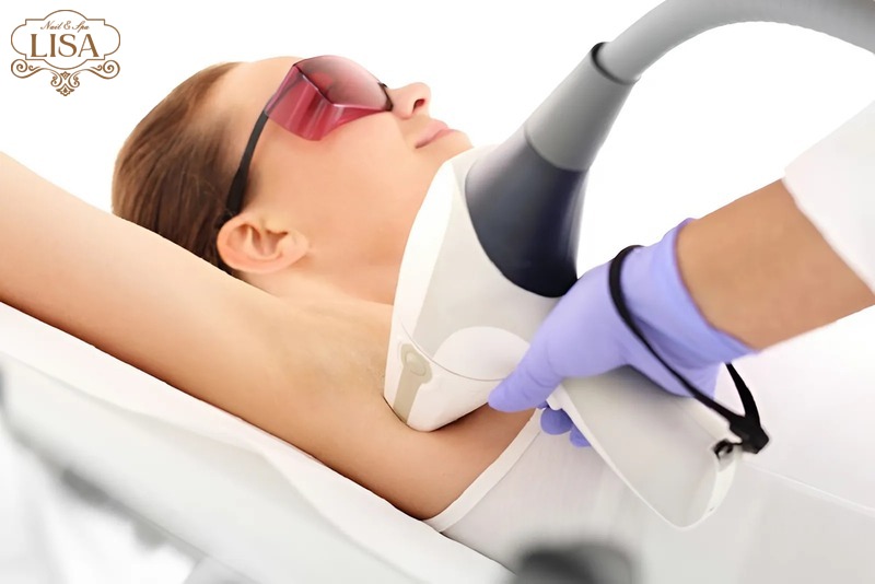 Triệt lông bằng Diode Laser là gì?