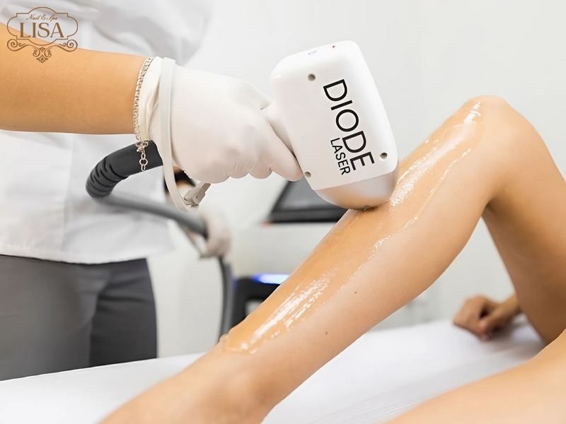 Triệt lông bằng Diode Laser là gì?