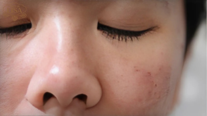 Triệt lông mặt có ảnh hưởng đến da không?