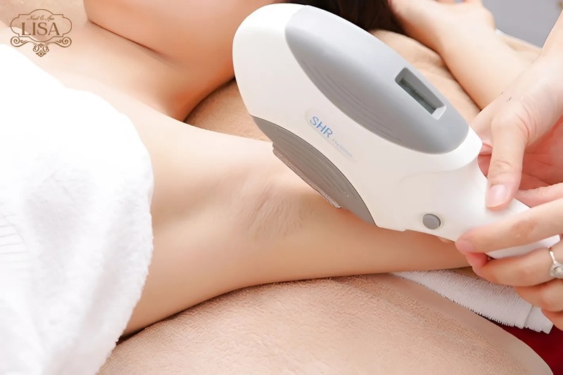 Triệt lông là gì?