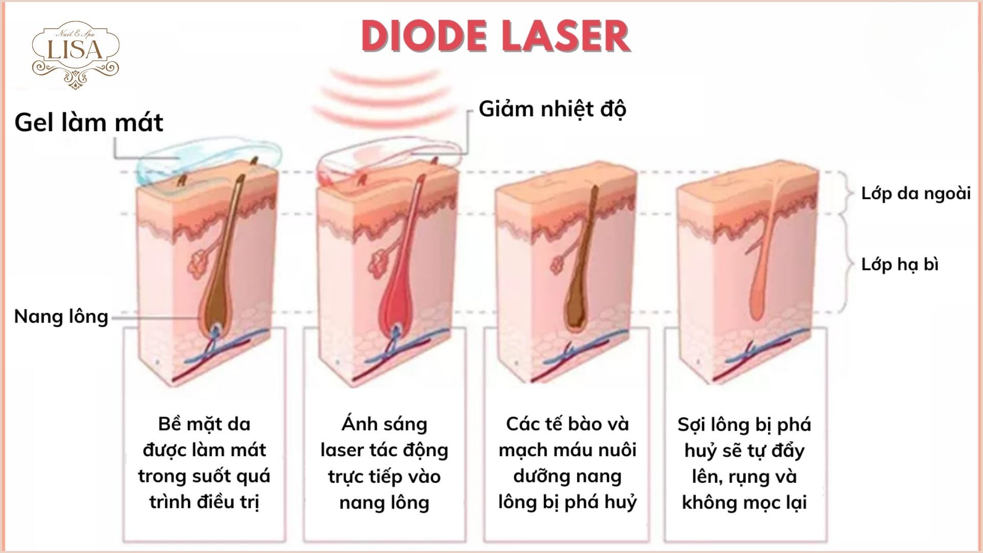 Triệt lông hiện đại tại Lisa Nail & Spa 