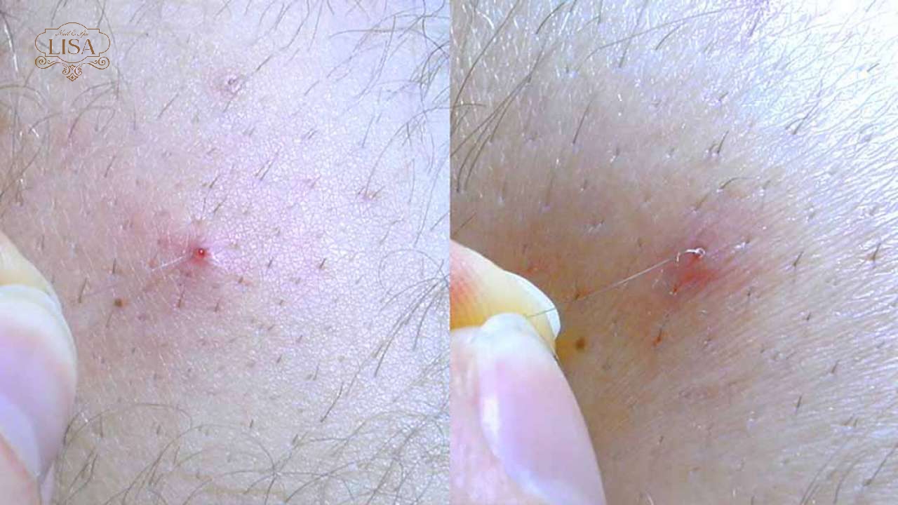 Hình ảnh lông mọc ngược