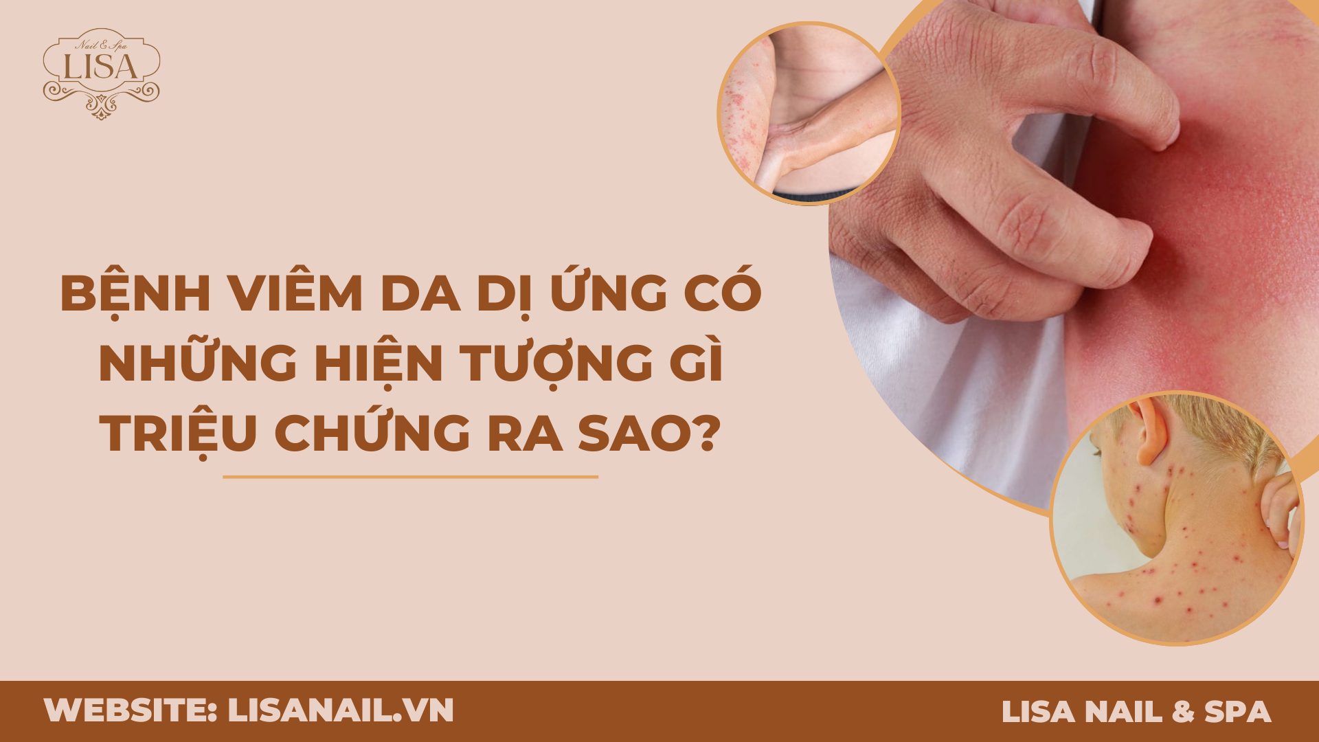 Bệnh viêm da dị ứng có những hiện tượng gì triệu chứng ra sao?