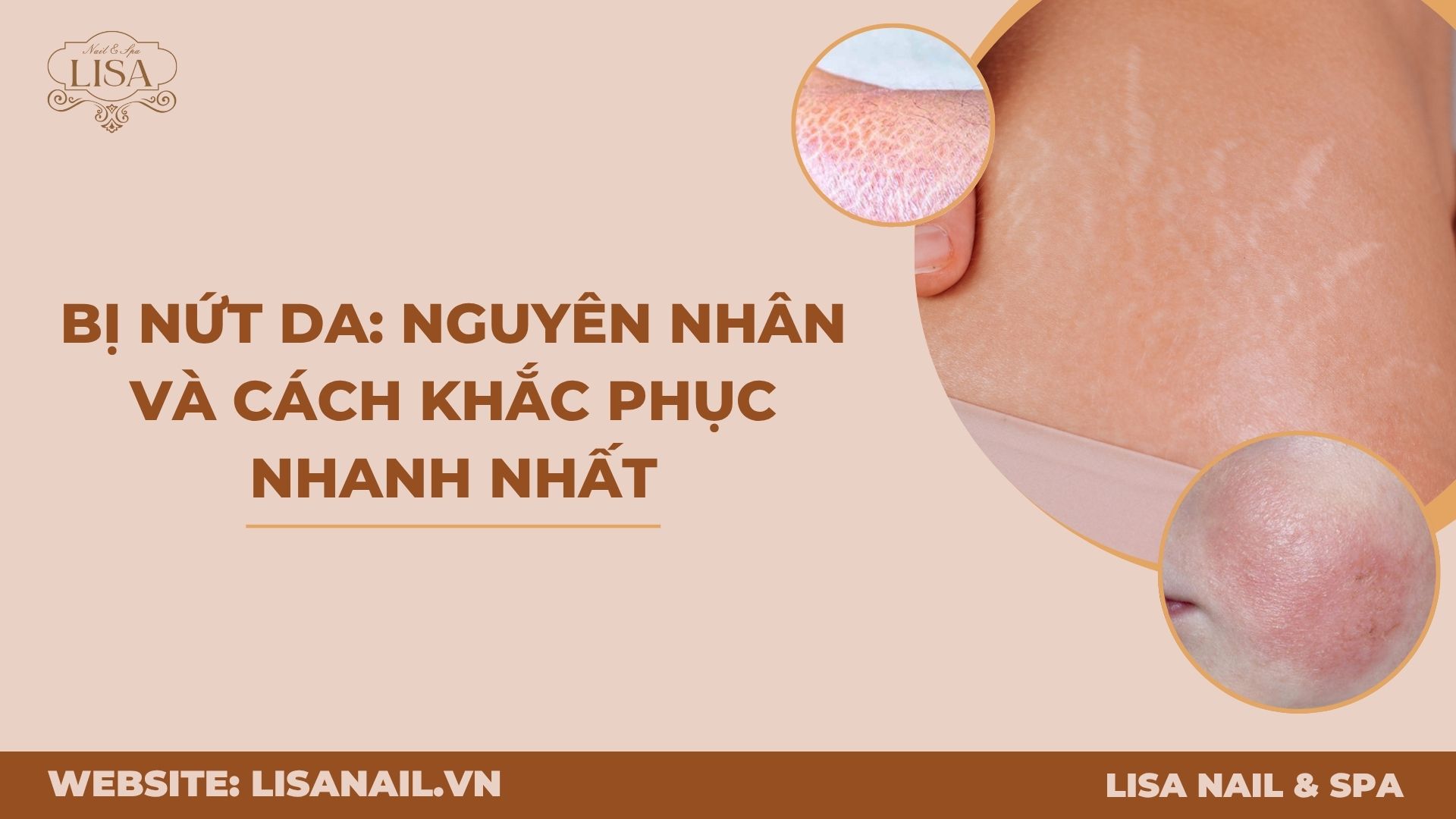 Bị nứt da: Nguyên nhân và cách khắc phục nhanh nhất