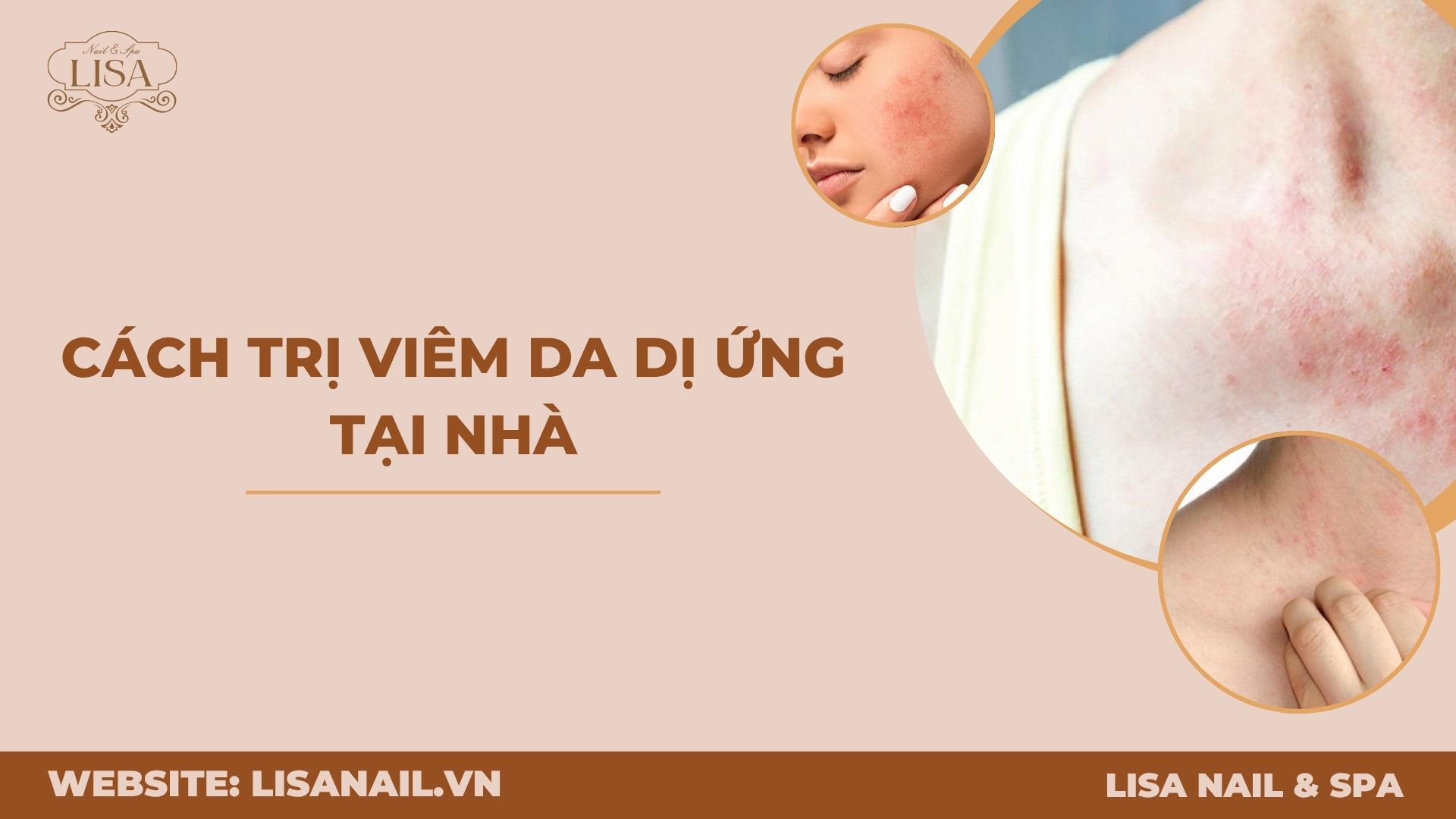 Cách trị viêm da dị ứng tại nhà