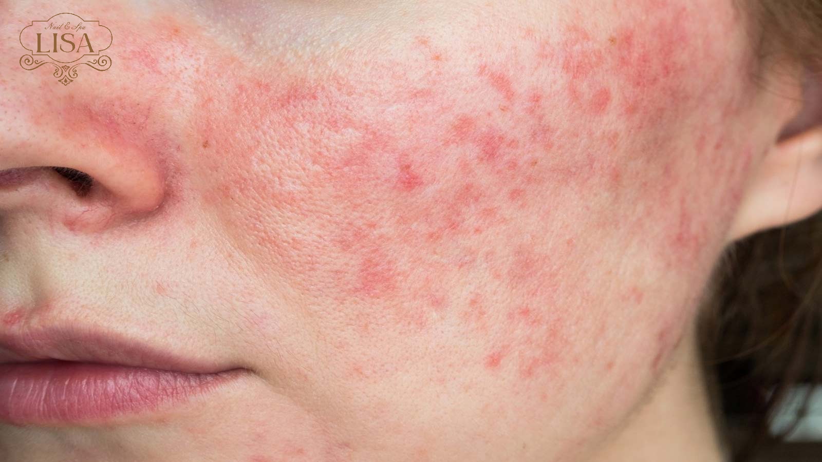 Da bị kích ứng 1