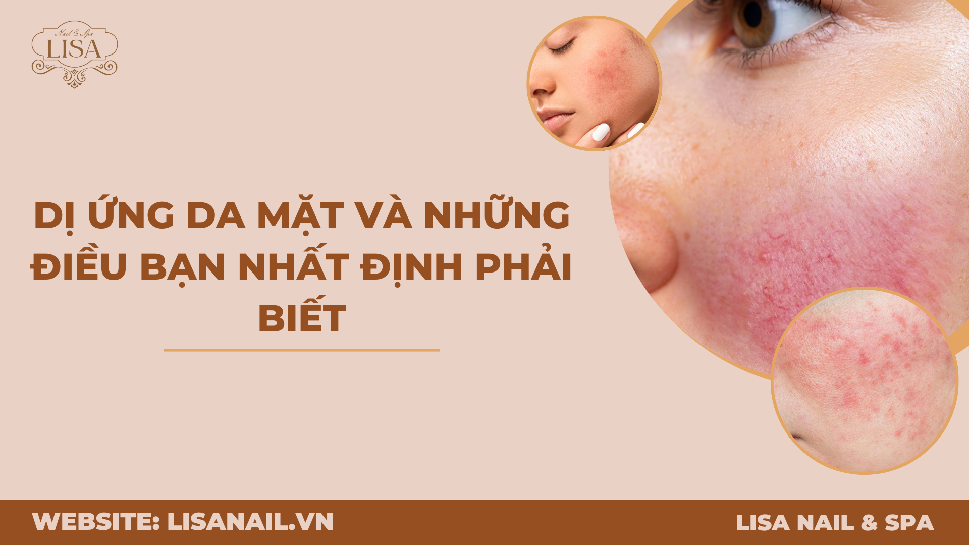 Dị ứng da mặt và những điều bạn nhất định phải biết