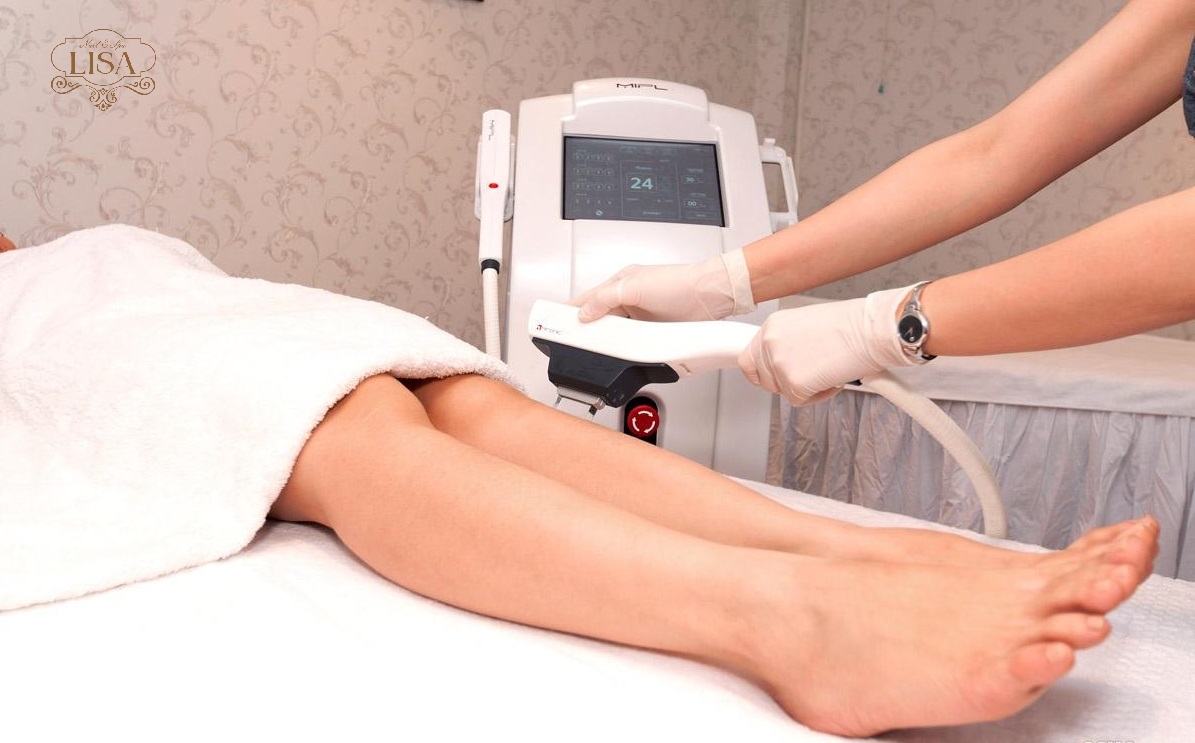 Dịch vụ triệt lông chân vĩnh viễn