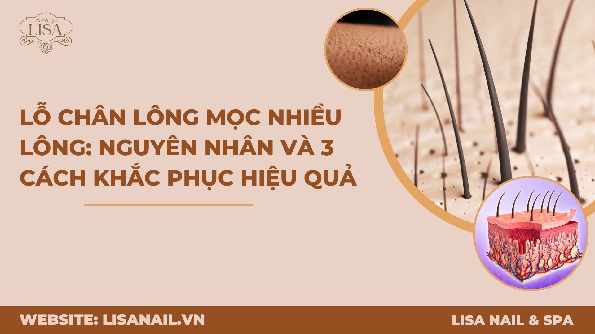 Lỗ chân lông mọc nhiều lông: Nguyên nhân và 3 cách khắc phục hiệu quả