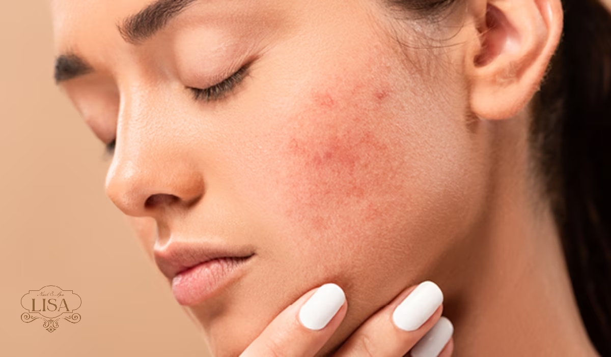 Phục hồi da mặt bị viêm