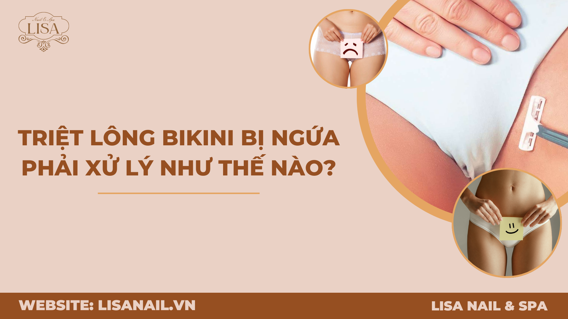 Triệt lông bikini bị ngứa phải xử lý như thế nào?