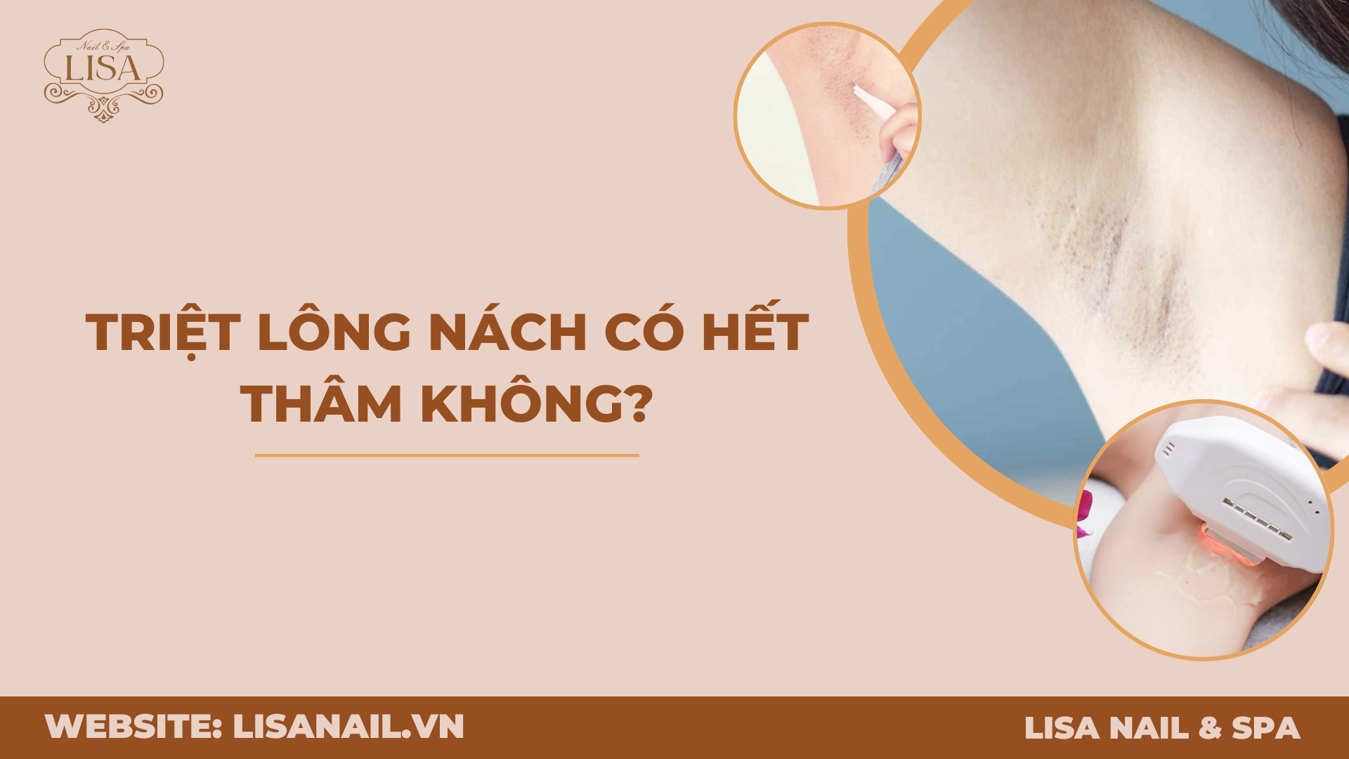 Triệt lông nách có hết thâm không?