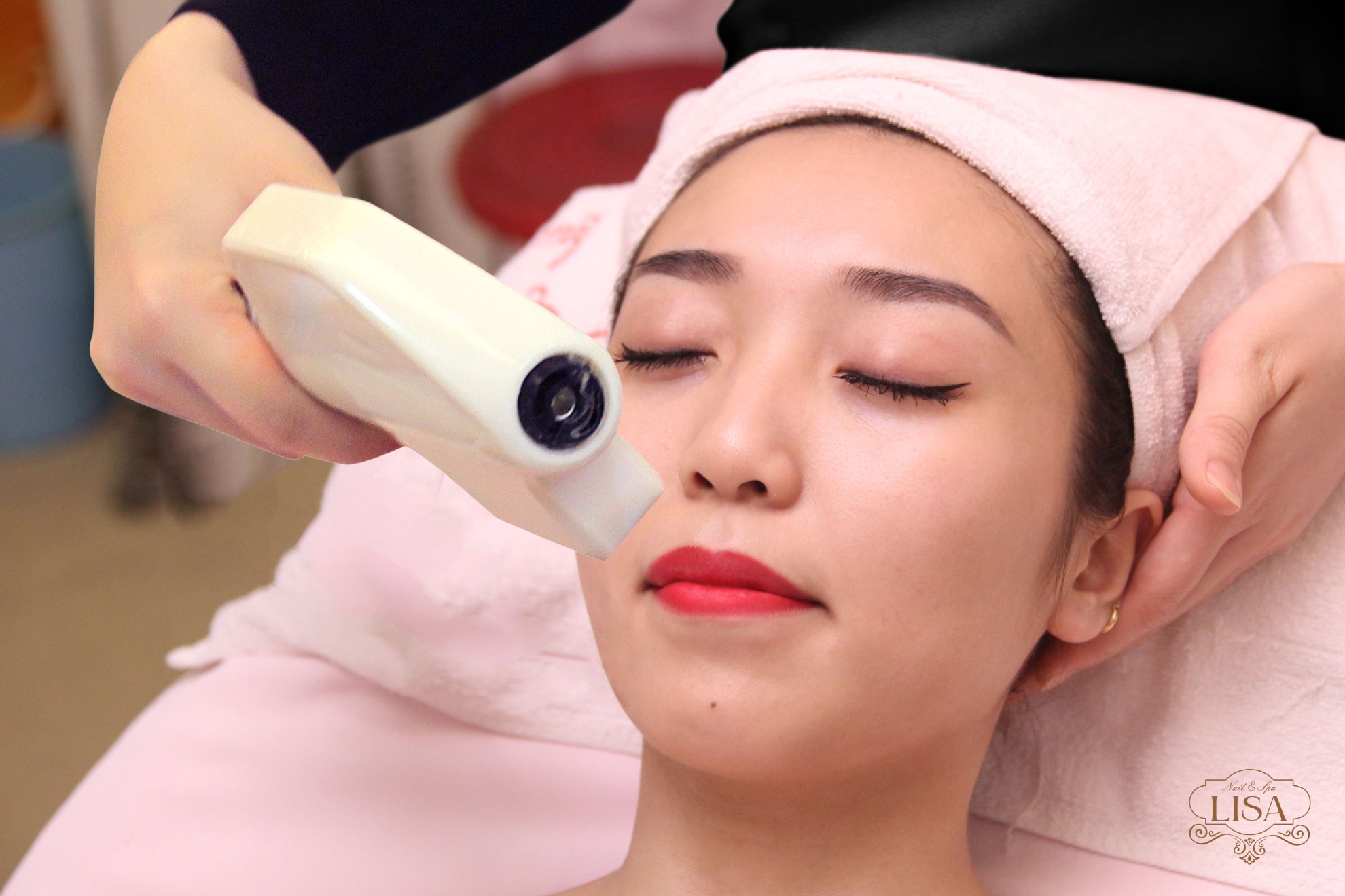 Triệt lông ria mép nữ
