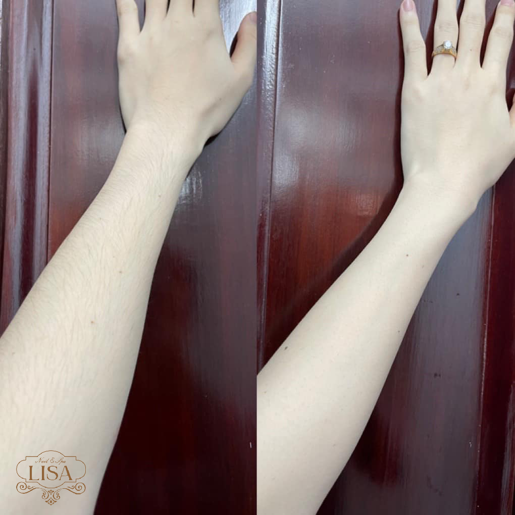 Triệt lông tay trước và sau