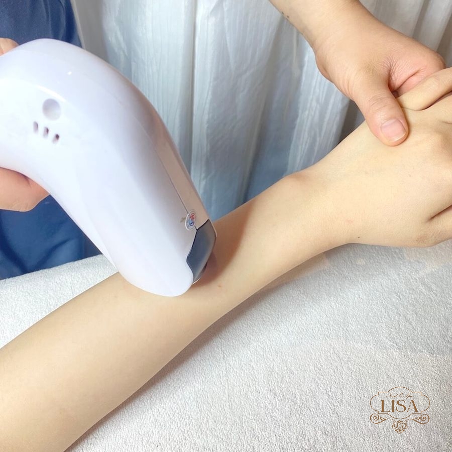 Triệt lông tay vĩnh viễn máy 1