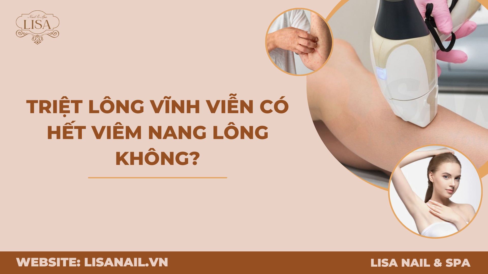 Triệt lông vĩnh viễn có hết viêm nang lông không?