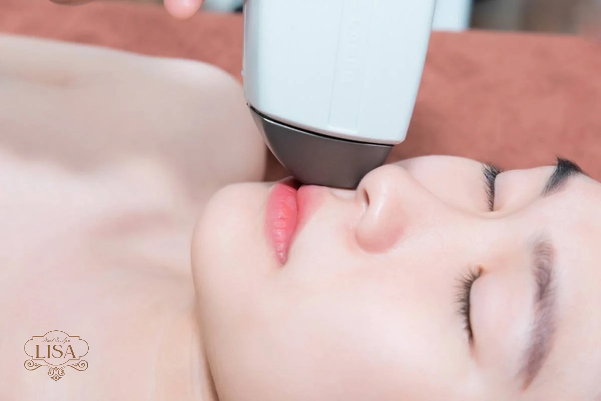 Triệt ria mép nữ vĩnh viễn