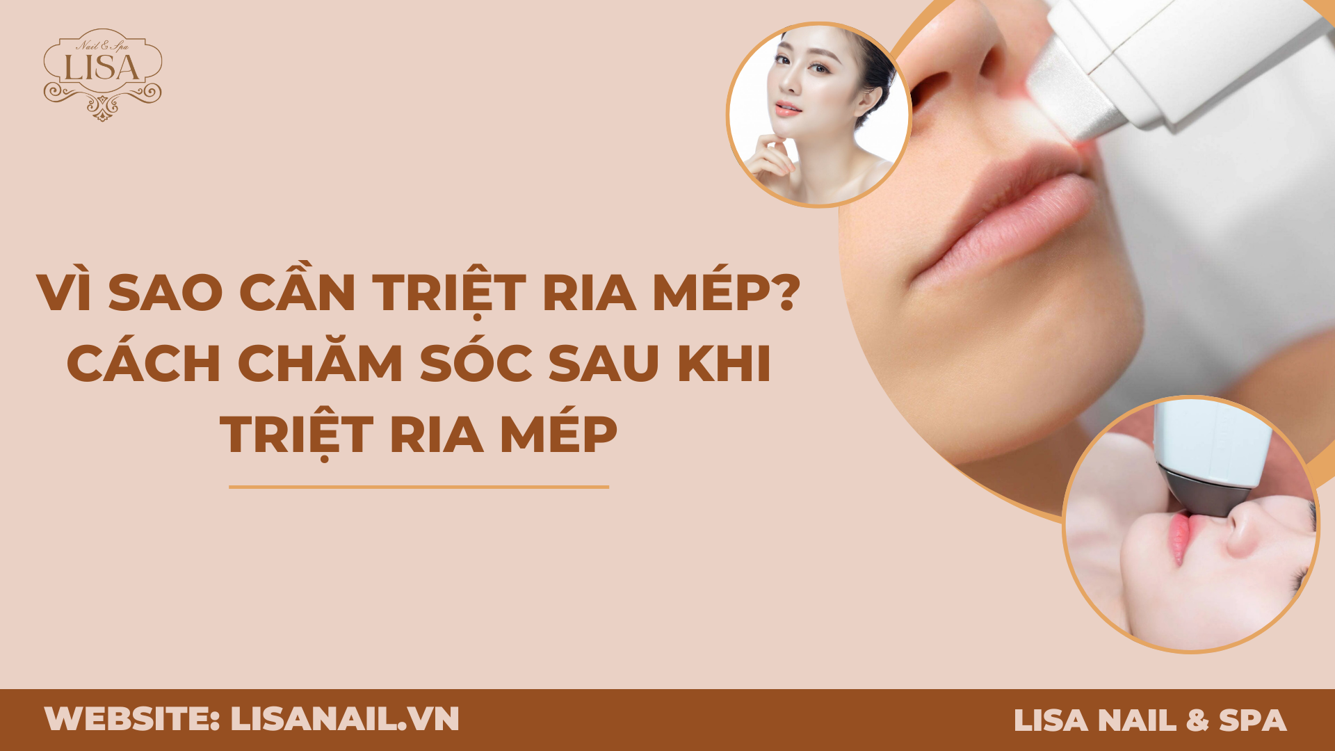 Vì sao cần triệt ria mép? Cách chăm sóc sau khi triệt ria mép