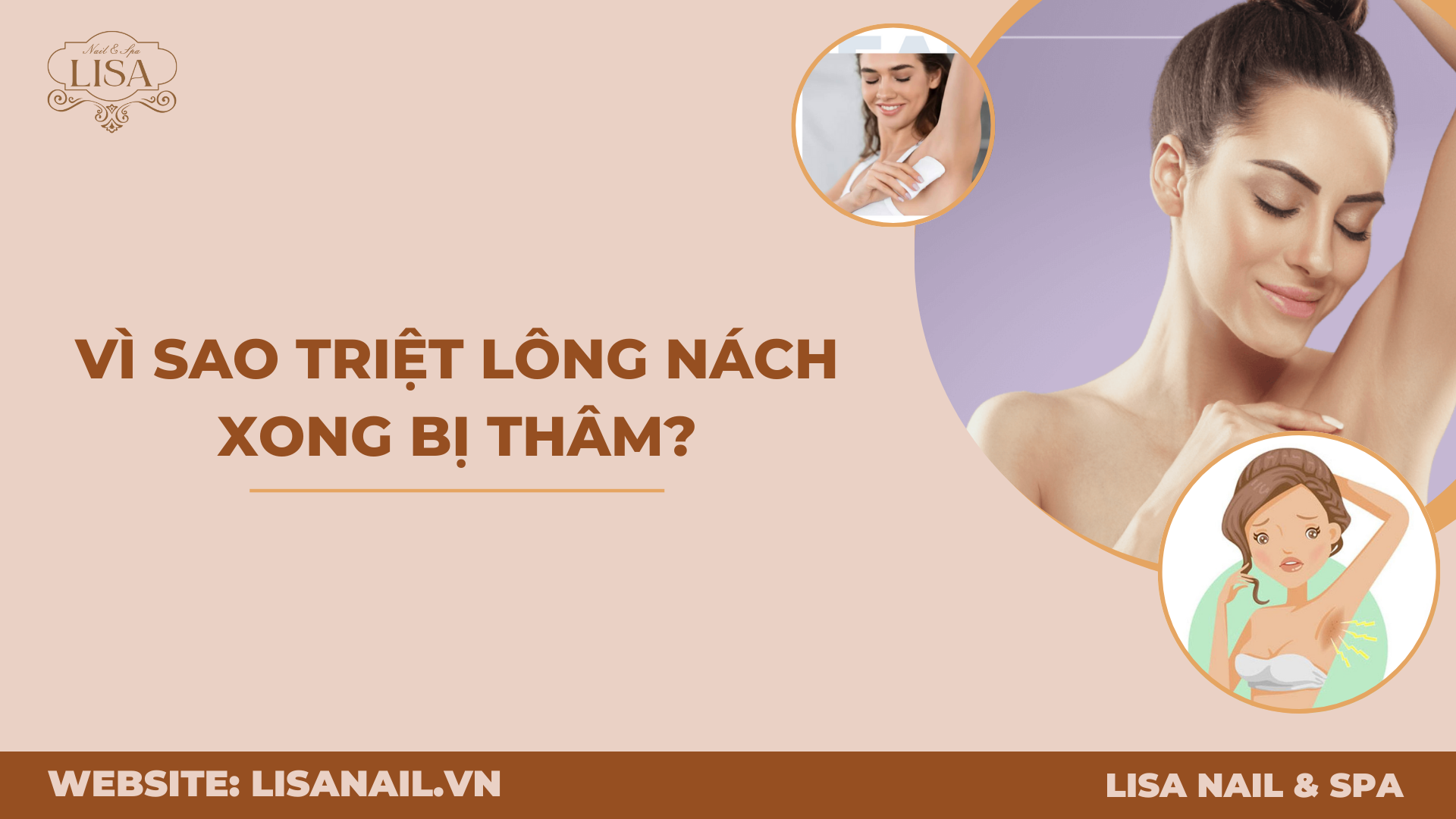 Vì sao triệt lông nách xong bị thâm?