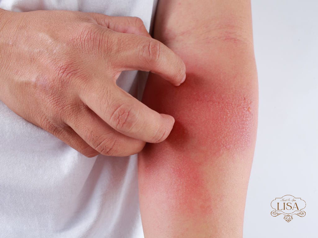 Viêm da mần đỏ