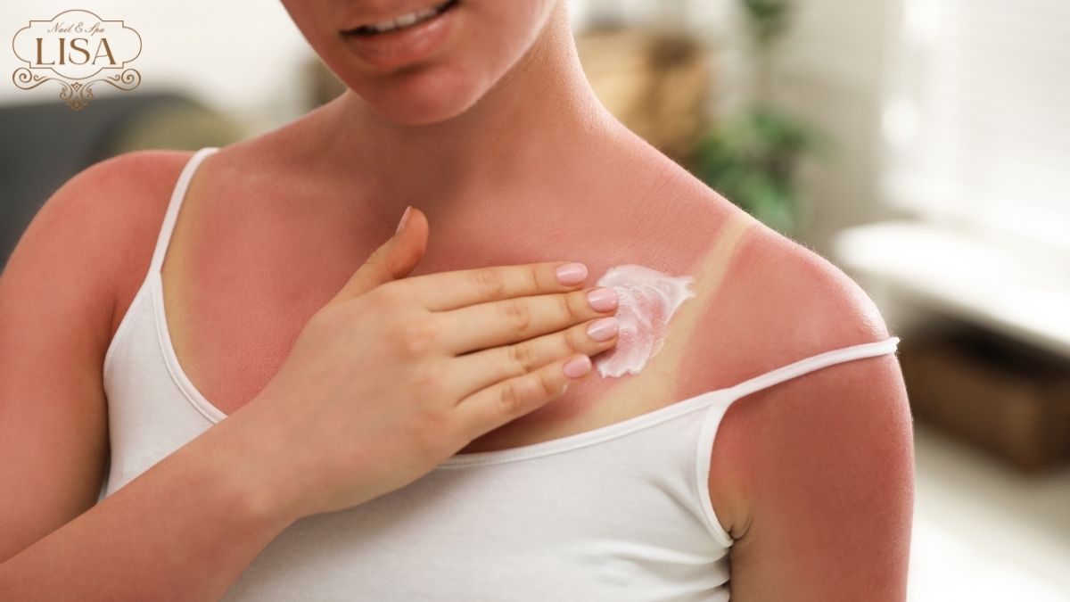 Cách dưỡng da bị cháy nắng