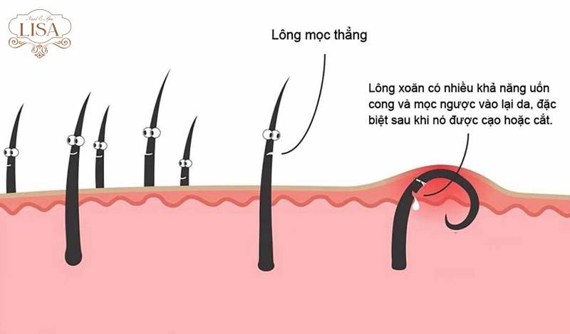 Lỗ chân lông mọc nhiều lông: Nguyên nhân và 3 cách khắc phục hiệu quả