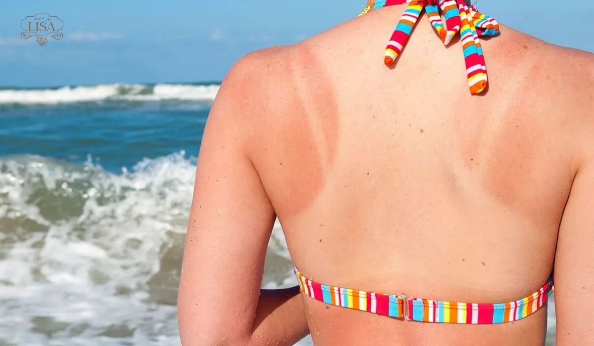 Nhả da cháy nắng