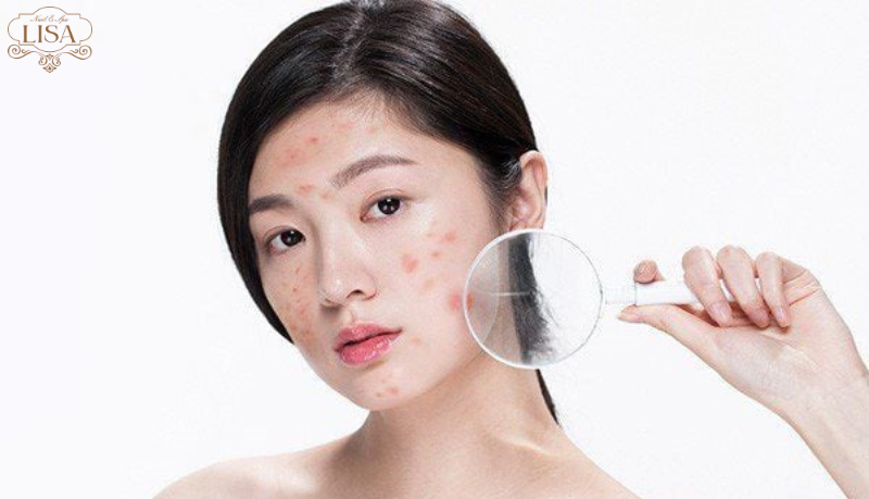 acne treatment facial ho chi minh