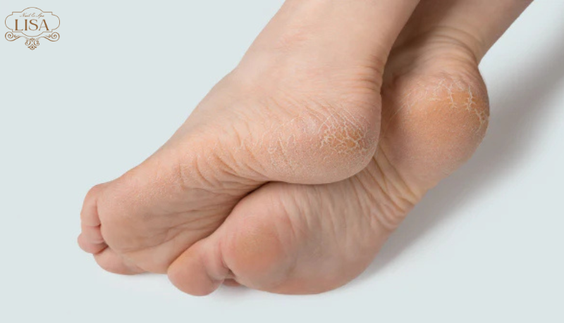 callus removal ho chi minh