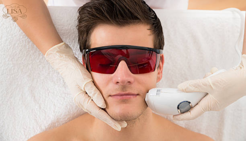  triệt râu vĩnh viễn