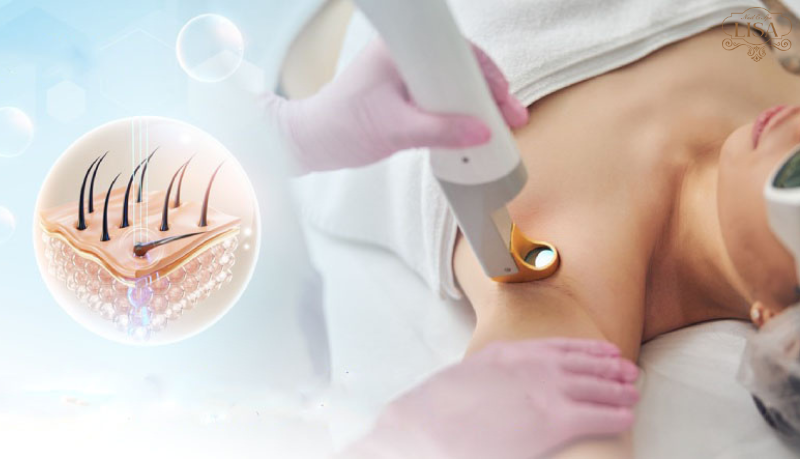 triệt lông vĩnh viễn có mọc lại không triệt lông vĩnh viễn có mọc lại không