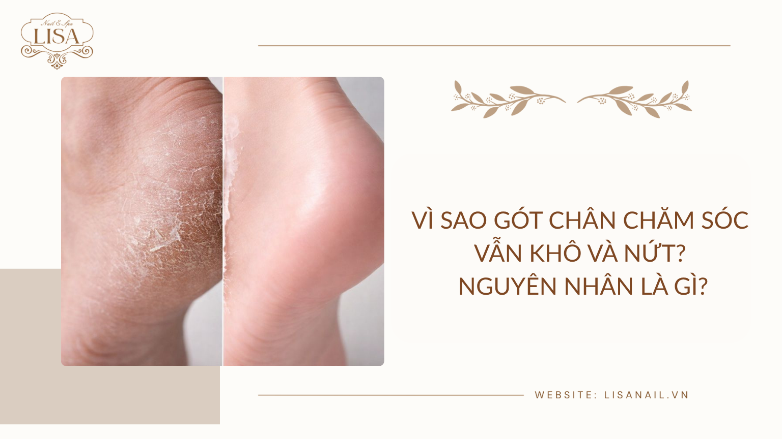 Vì sao gót chân chăm sóc vẫn khô và nứt? Nguyên nhân là gì?